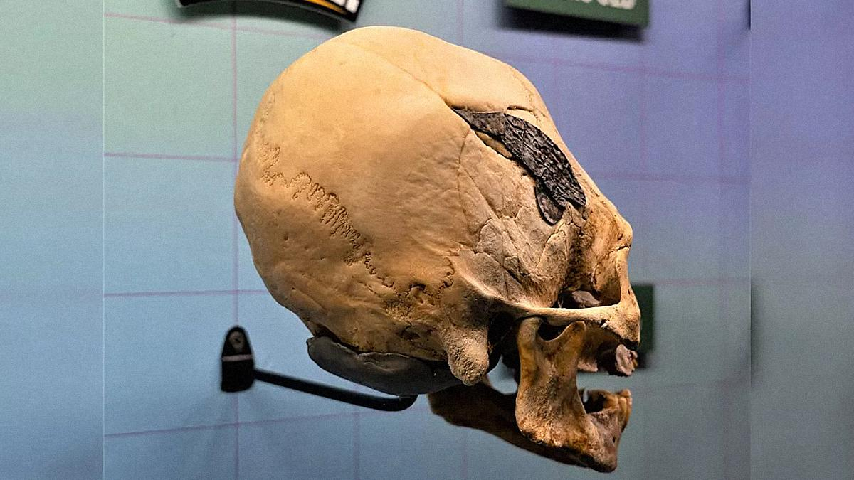 Древній череп із металевим імплантатом викликав сумніви у своїй автентичності - Новини технологій - Техно